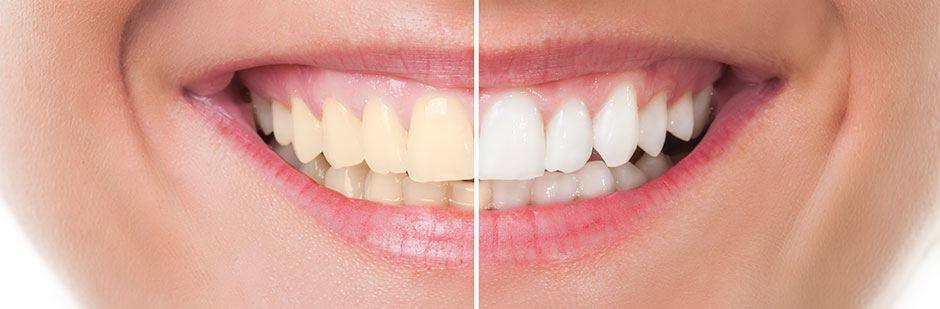 Smile showing before and after of teeth whitening.