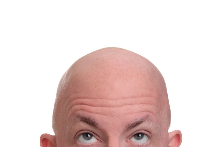 19may consumer in the 80s baldness