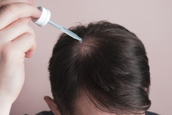 22jul balding treatments minoxidil width