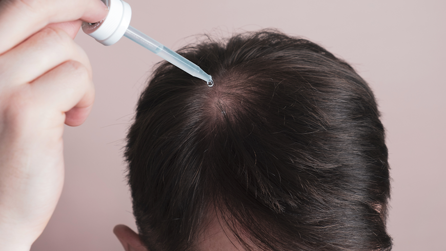 22jul balding treatments minoxidil width
