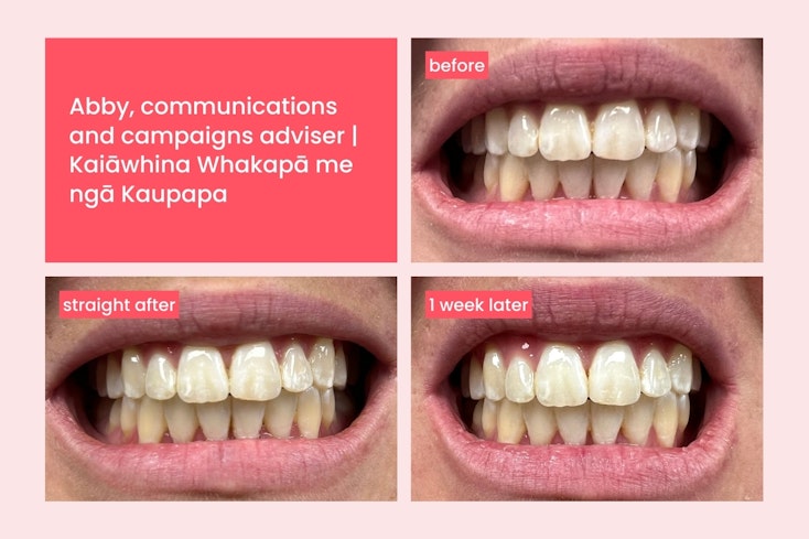 Hismile teeth whitening width