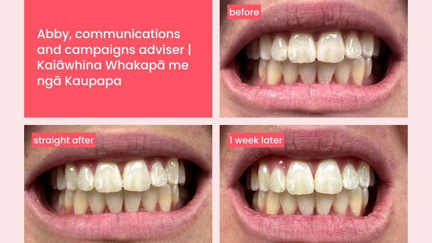 Hismile teeth whitening width