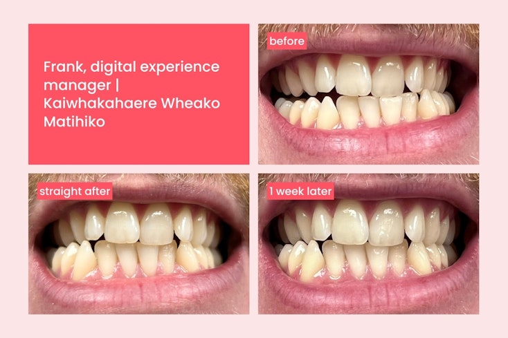 Hismile teeth whitening  1  width