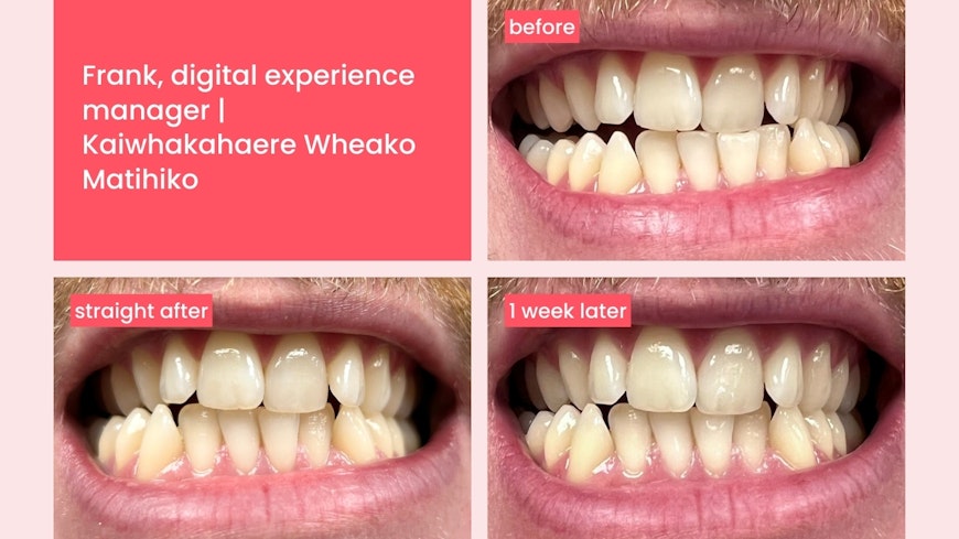 Hismile teeth whitening 1 width