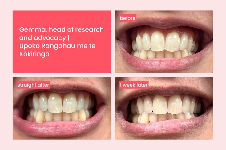 Hismile teeth whitening  2  width