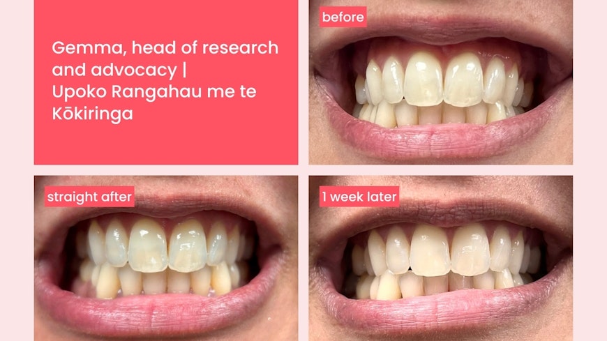 Hismile teeth whitening 2 width