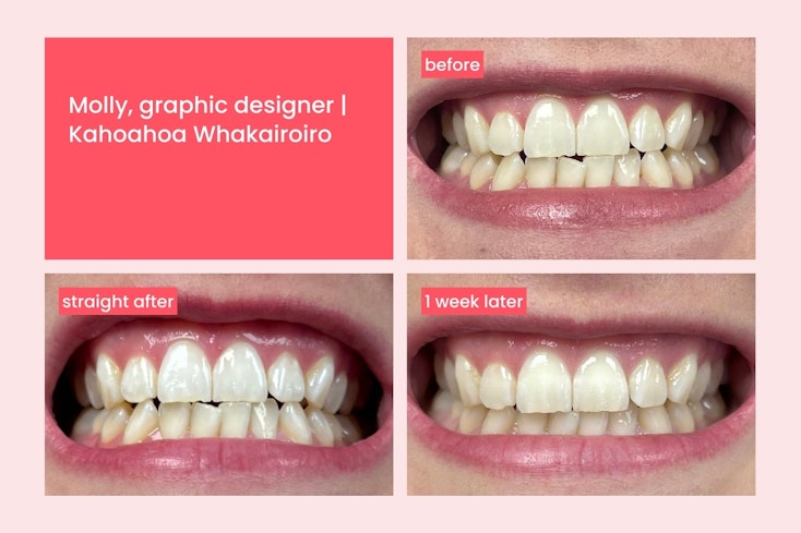 Hismile teeth whitening  3  width