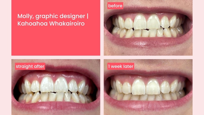 Hismile teeth whitening 3 width